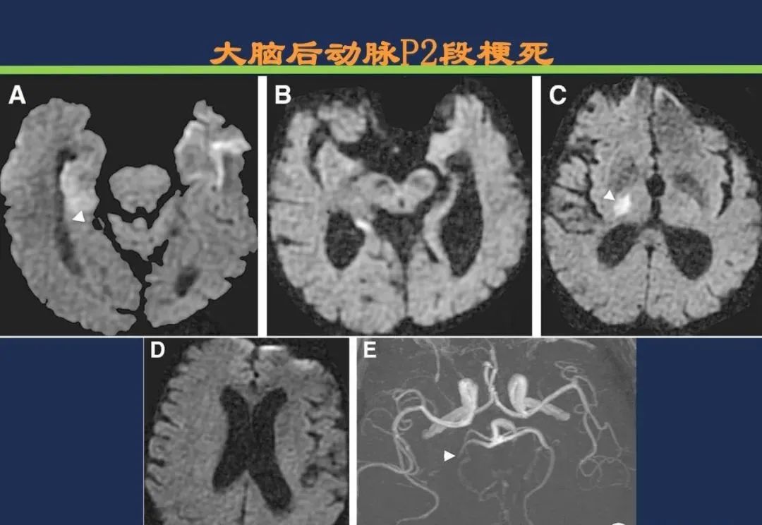 从梗死部位推测责任血管：脑血管解剖-96