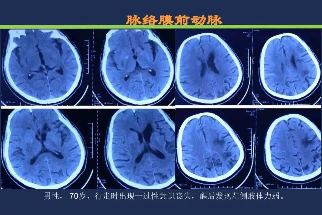 从梗死部位推测责任血管：脑血管解剖-82