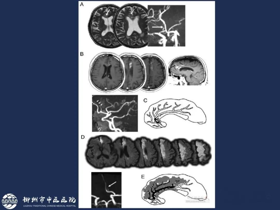 从梗死部位推测责任血管：脑血管解剖-62