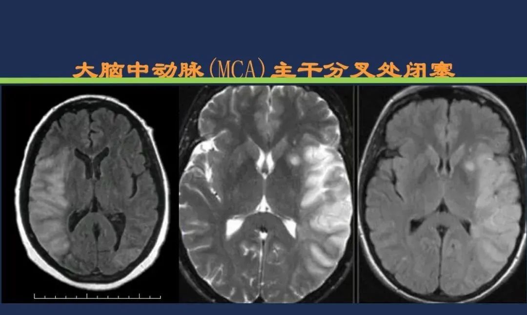 从梗死部位推测责任血管：脑血管解剖-44