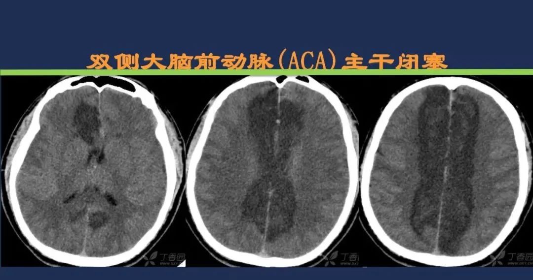 从梗死部位推测责任血管：脑血管解剖-59
