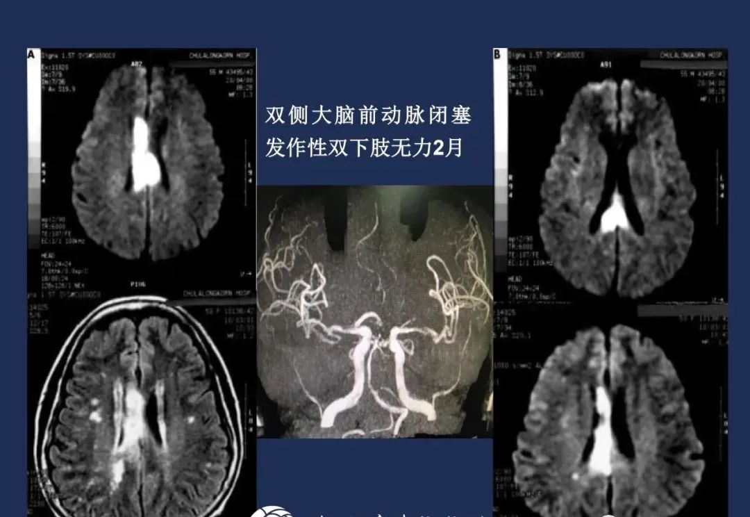 从梗死部位推测责任血管：脑血管解剖-63
