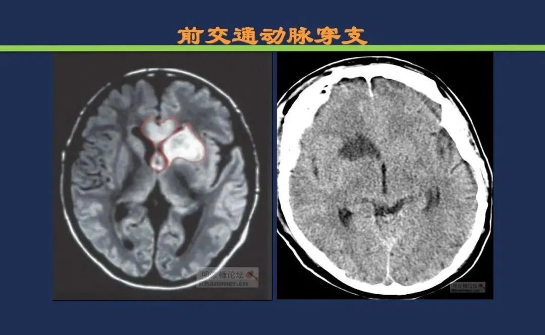 从梗死部位推测责任血管：脑血管解剖-65