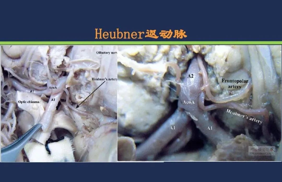 从梗死部位推测责任血管：脑血管解剖-67