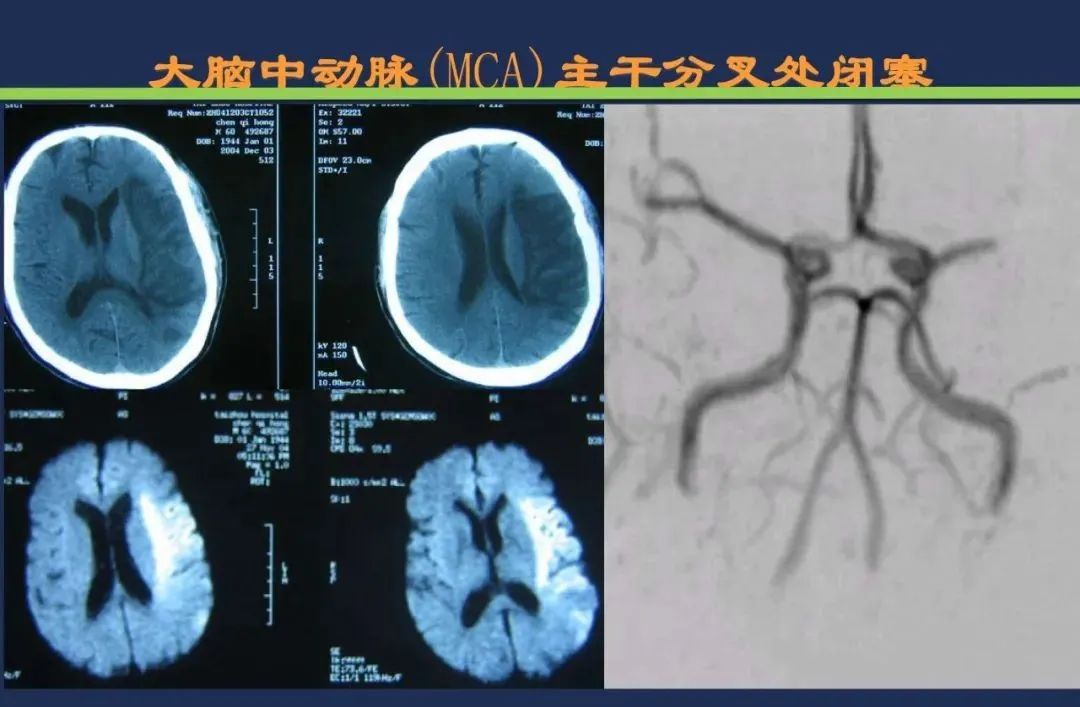 从梗死部位推测责任血管：脑血管解剖-43