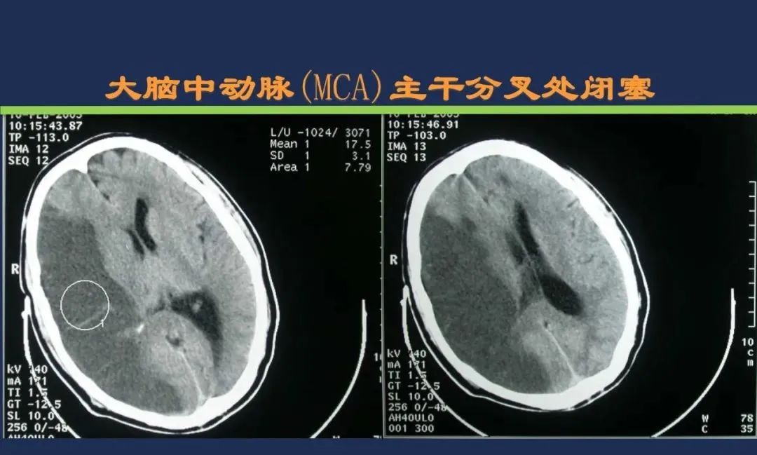 从梗死部位推测责任血管：脑血管解剖-40