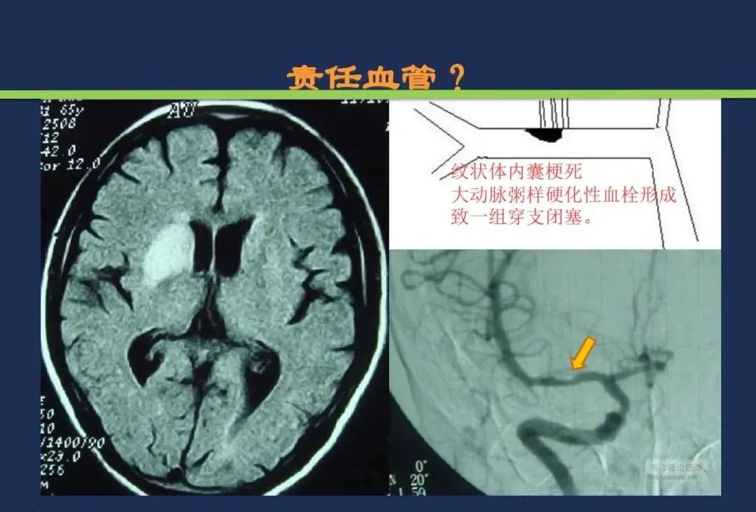 从梗死部位推测责任血管：脑血管解剖-72