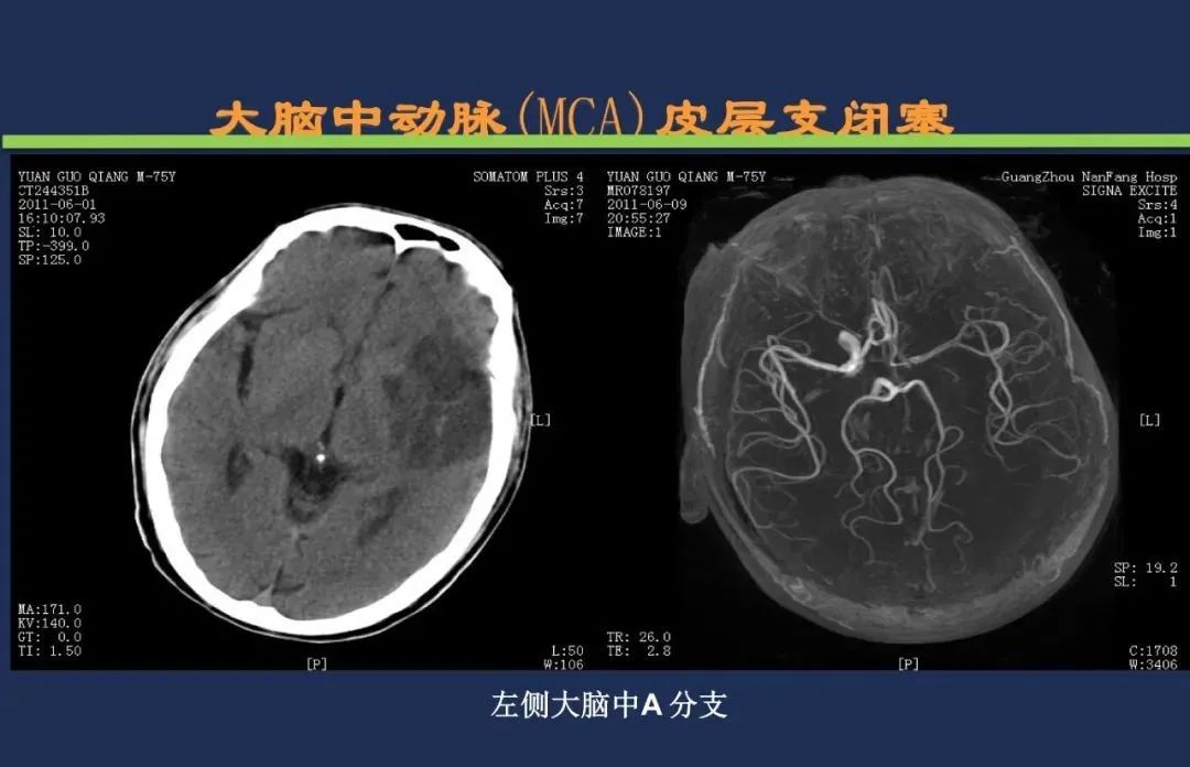 从梗死部位推测责任血管：脑血管解剖-48
