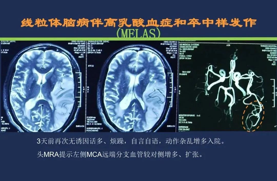 从梗死部位推测责任血管：脑血管解剖-51