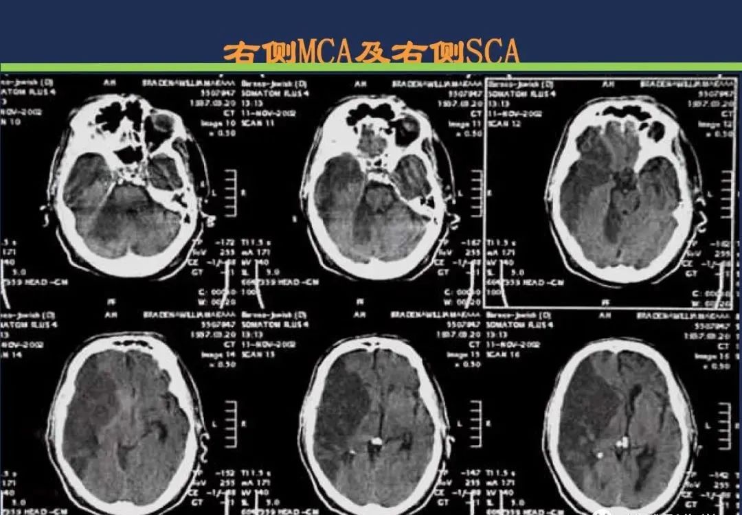 从梗死部位推测责任血管：脑血管解剖-53