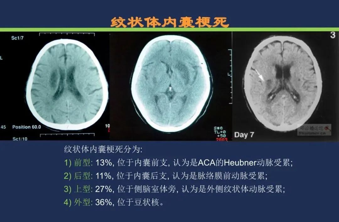 从梗死部位推测责任血管：脑血管解剖-69