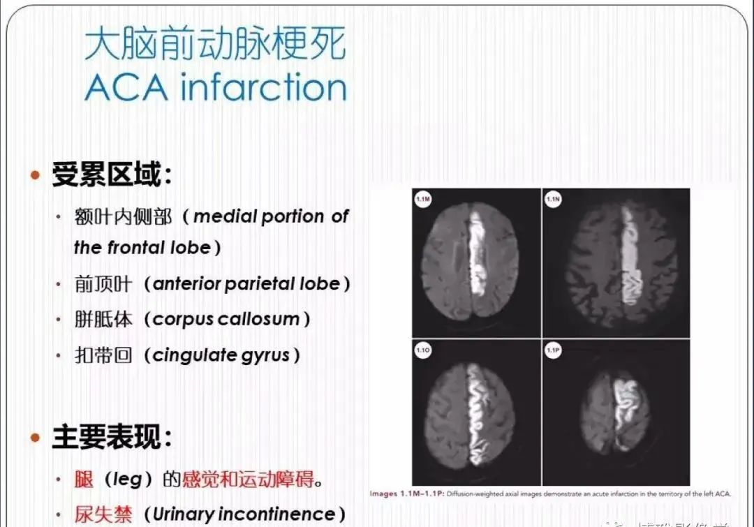 从梗死部位推测责任血管：脑血管解剖-56