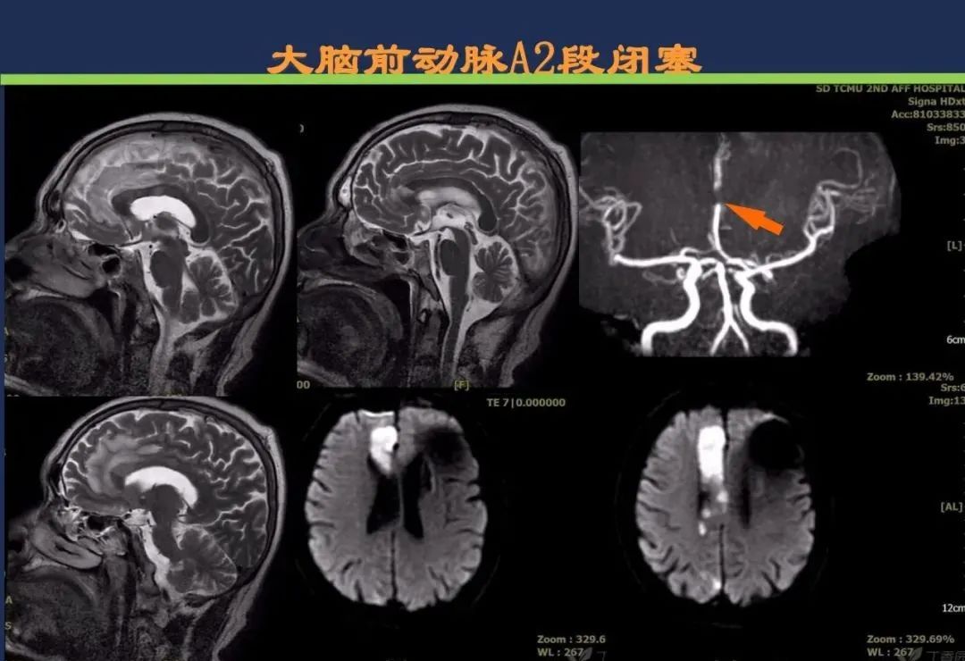 从梗死部位推测责任血管：脑血管解剖-64