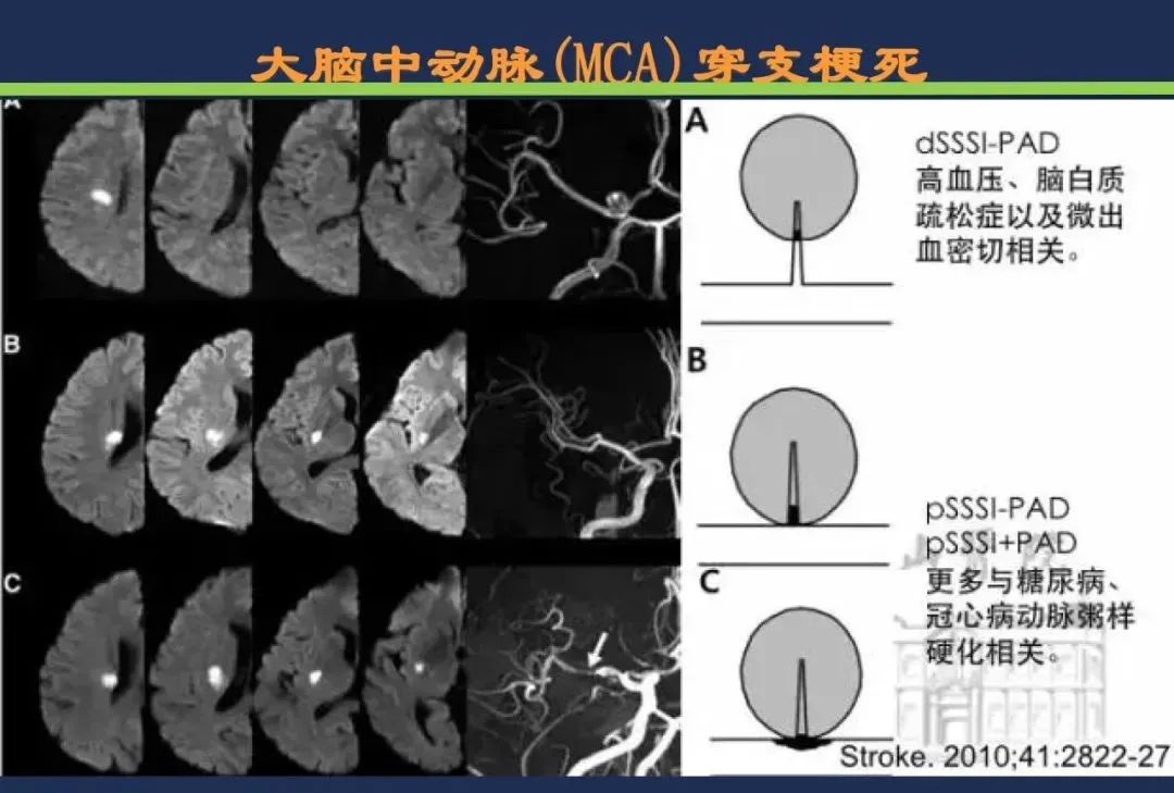 从梗死部位推测责任血管：脑血管解剖-42