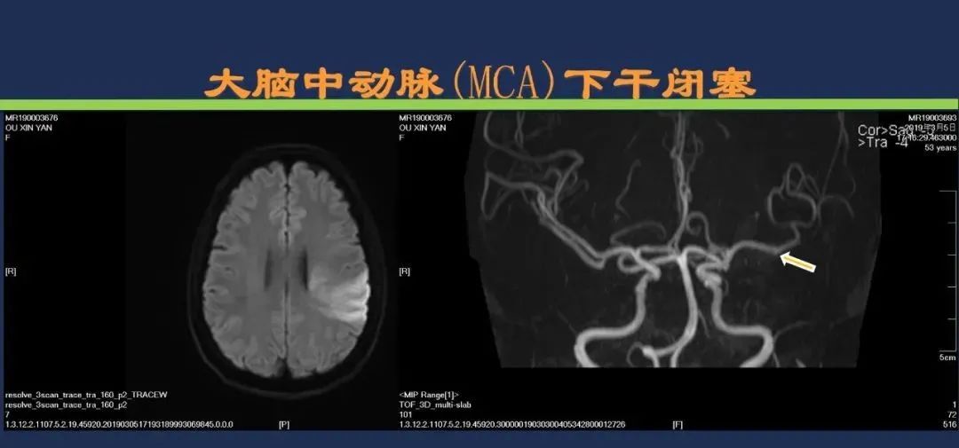 从梗死部位推测责任血管：脑血管解剖-47