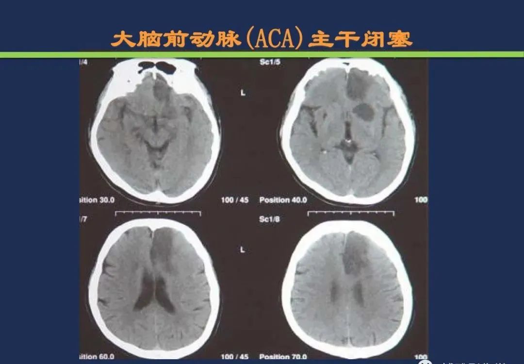 从梗死部位推测责任血管：脑血管解剖-58