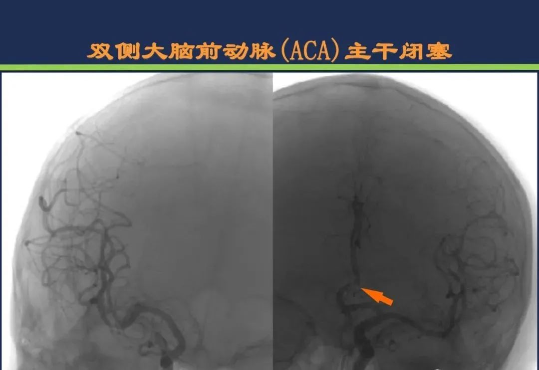 从梗死部位推测责任血管：脑血管解剖-60
