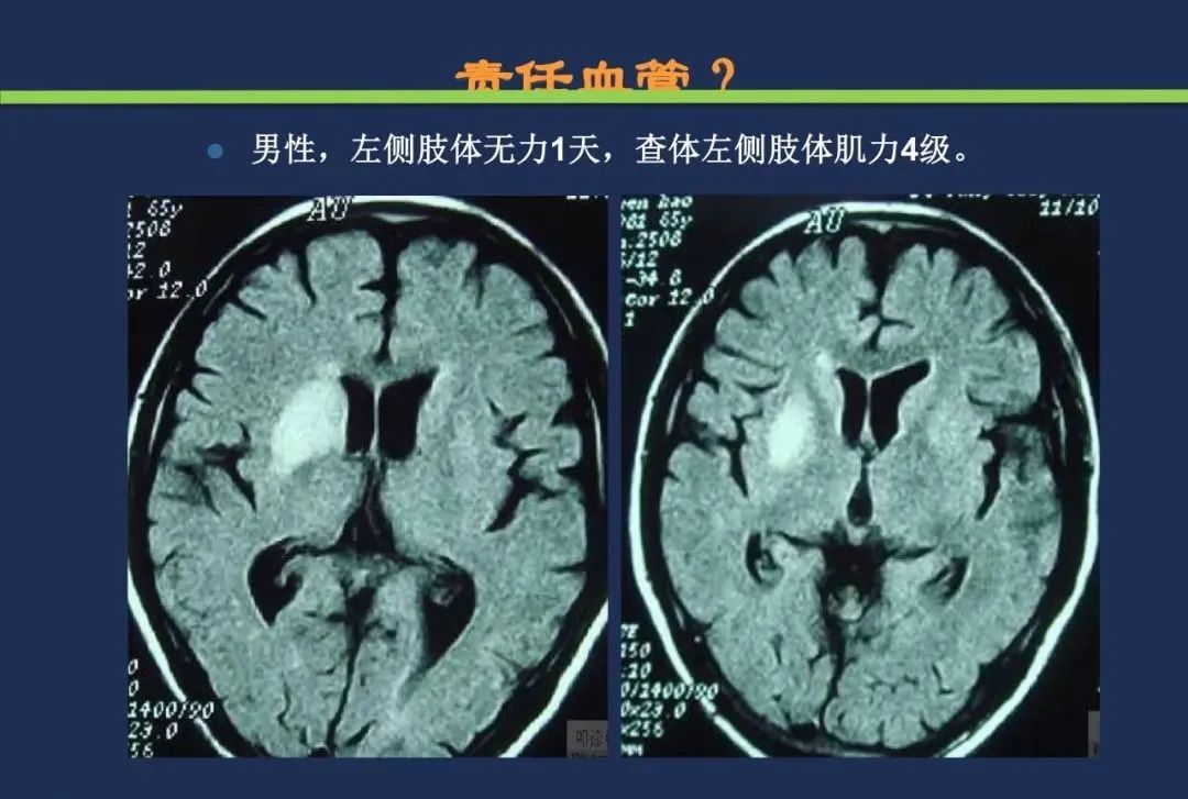 从梗死部位推测责任血管：脑血管解剖-71
