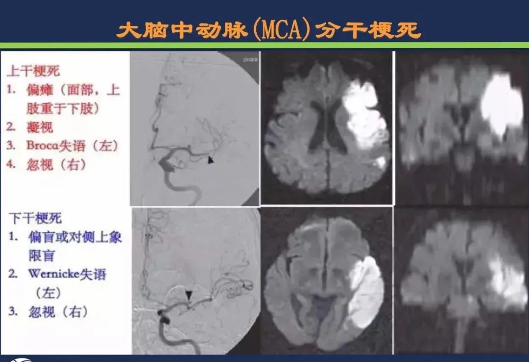 从梗死部位推测责任血管：脑血管解剖-41