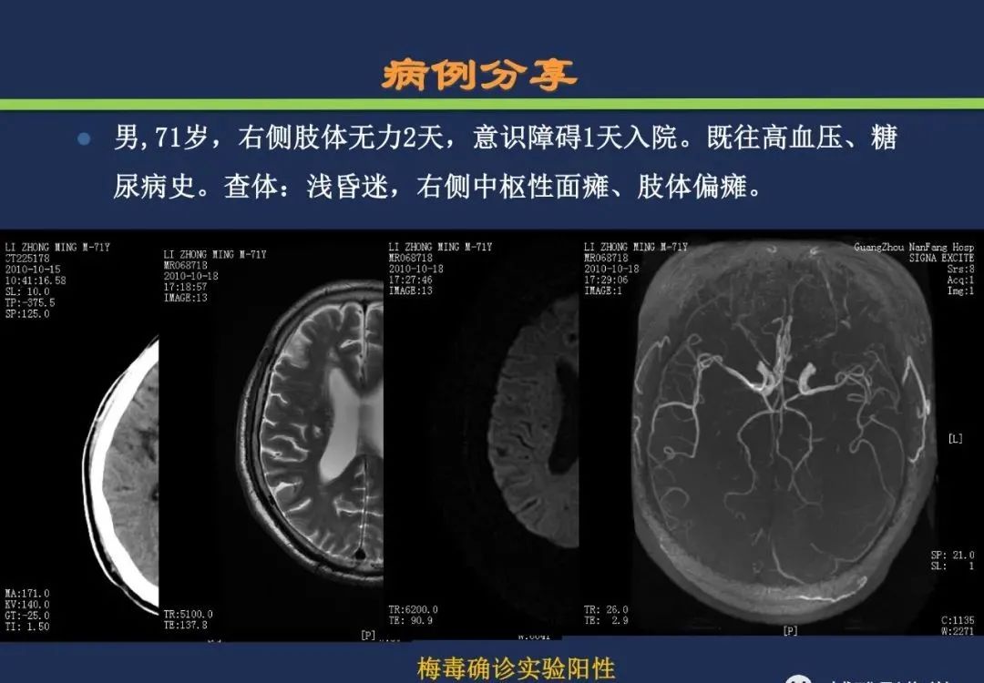 从梗死部位推测责任血管：脑血管解剖-52