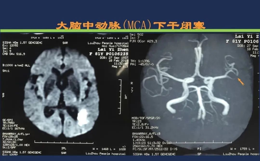 从梗死部位推测责任血管：脑血管解剖-46
