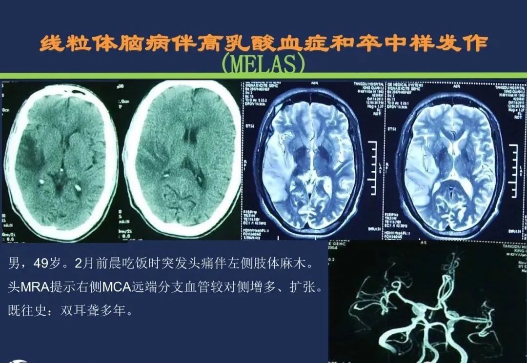 从梗死部位推测责任血管：脑血管解剖-50