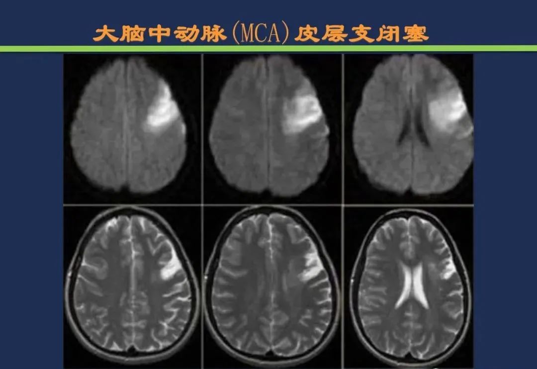 从梗死部位推测责任血管：脑血管解剖-49