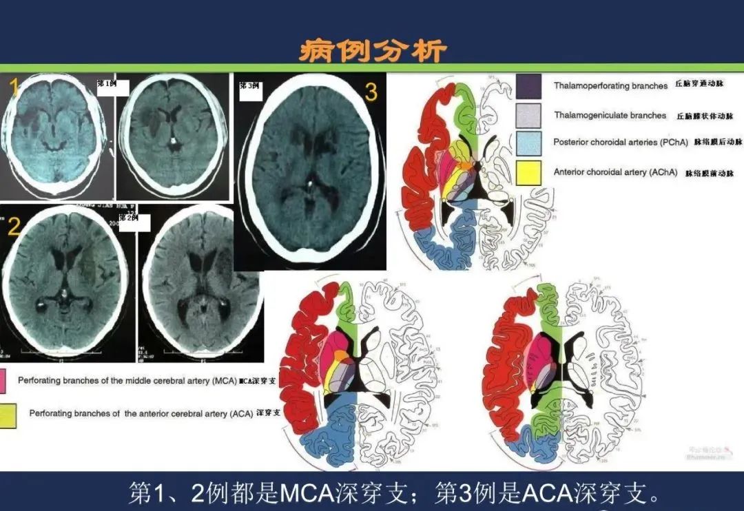 从梗死部位推测责任血管：脑血管解剖-73
