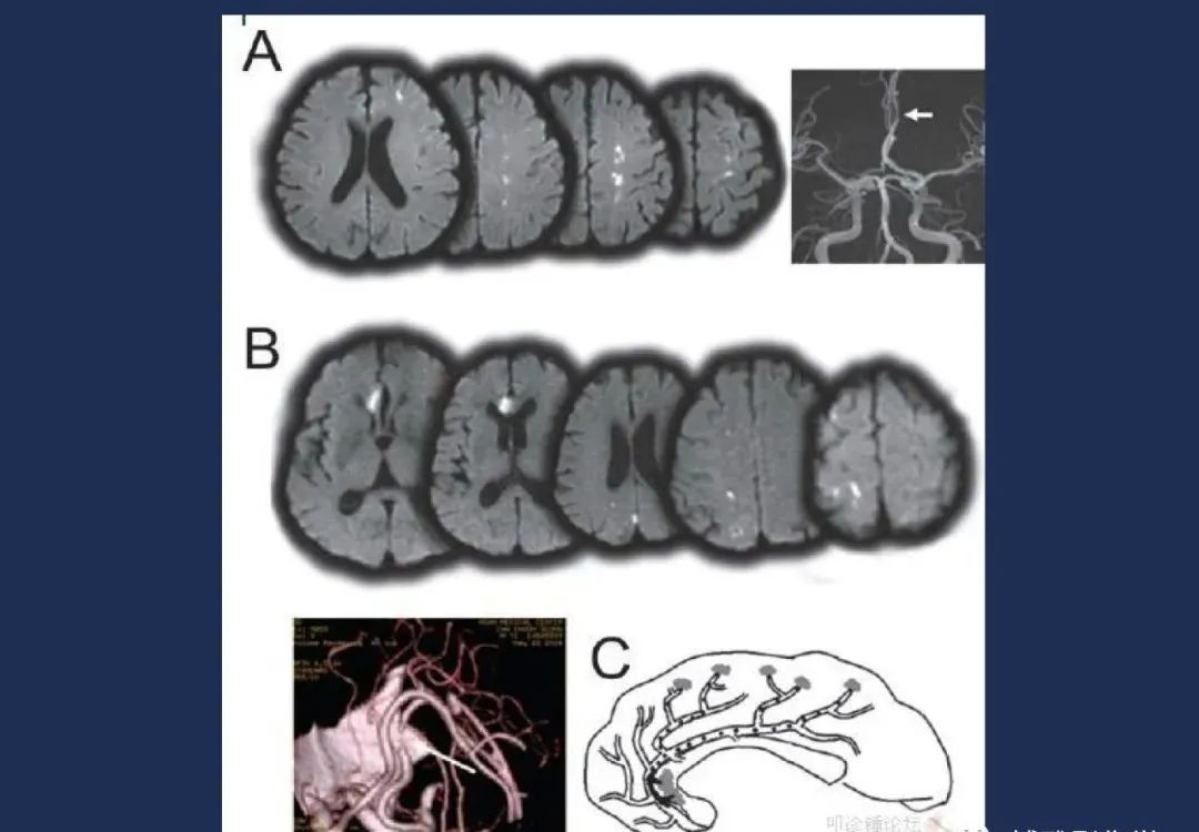 从梗死部位推测责任血管：脑血管解剖-61
