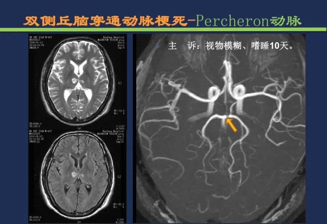 从梗死部位推测责任血管：脑血管解剖-111