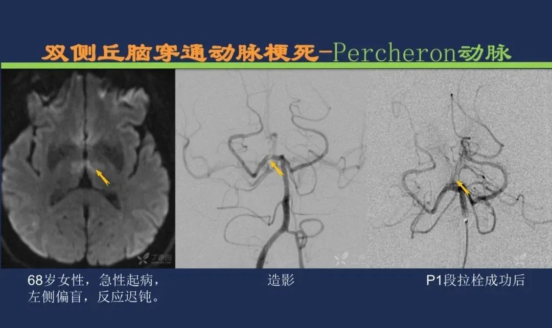 从梗死部位推测责任血管：脑血管解剖-110