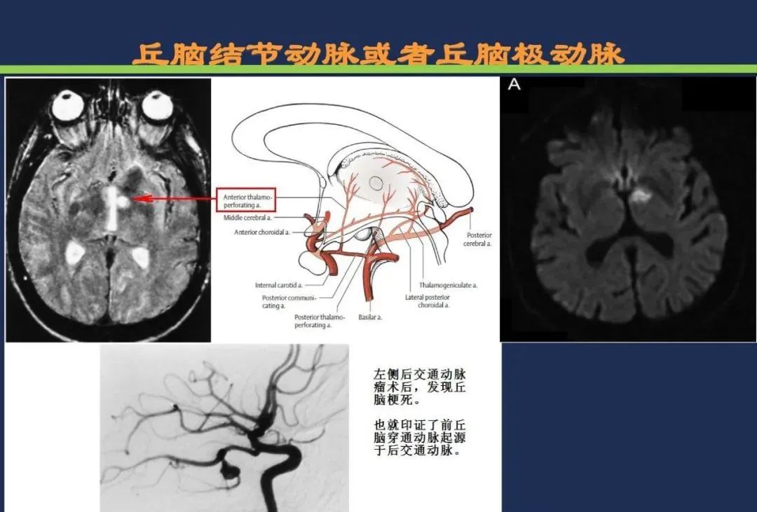 从梗死部位推测责任血管：脑血管解剖-115