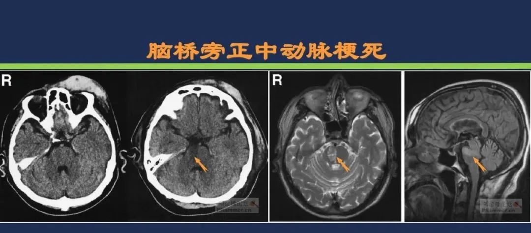从梗死部位推测责任血管：脑血管解剖-134