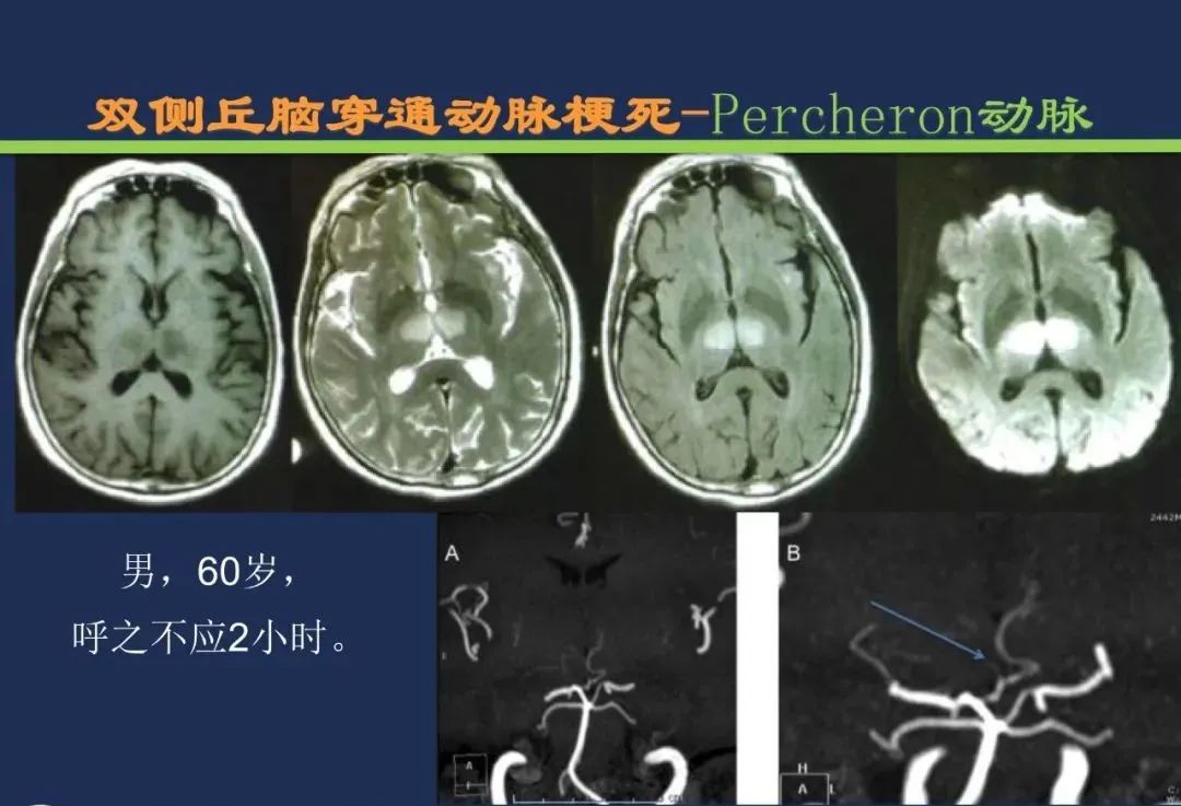 从梗死部位推测责任血管：脑血管解剖-114