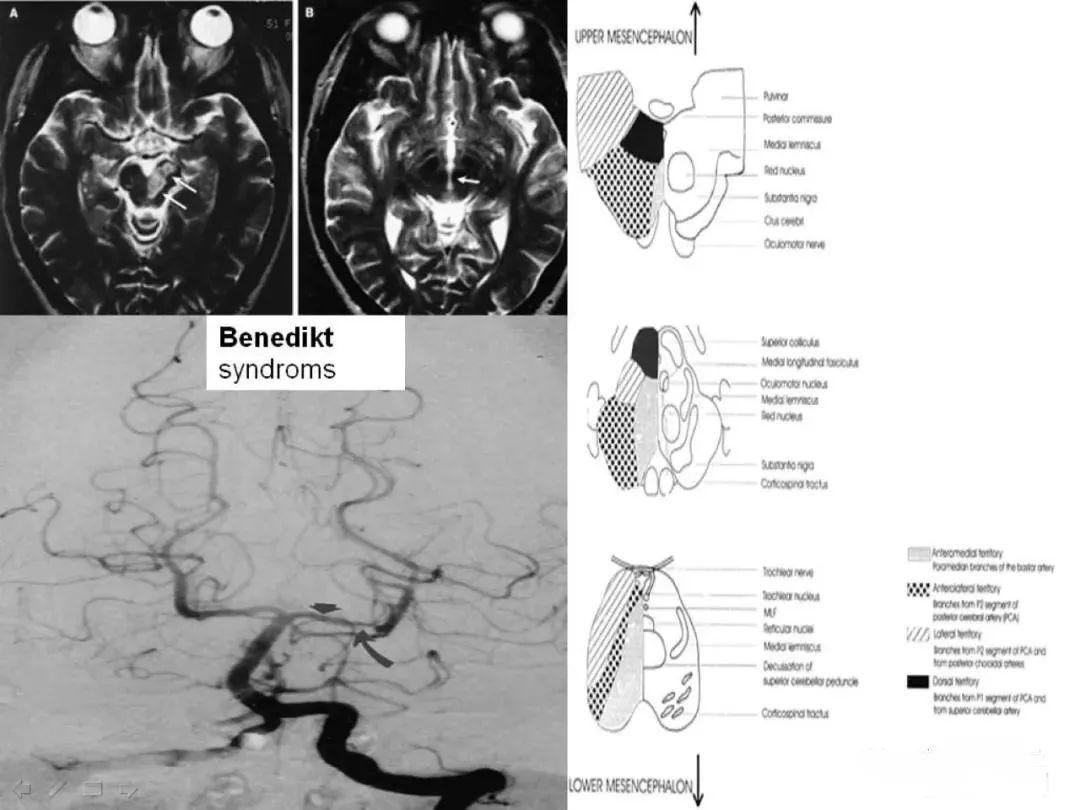 从梗死部位推测责任血管：脑血管解剖-146