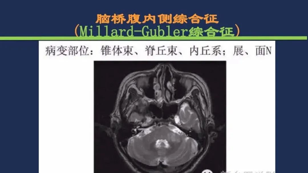从梗死部位推测责任血管：脑血管解剖-140
