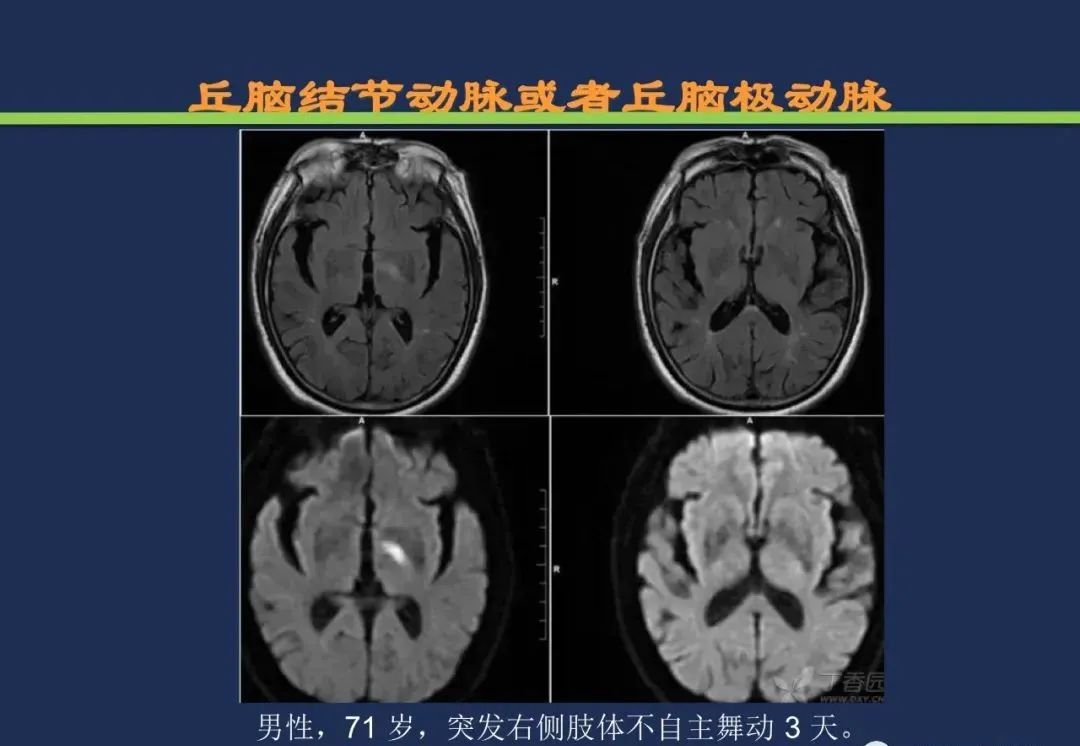 从梗死部位推测责任血管：脑血管解剖-117