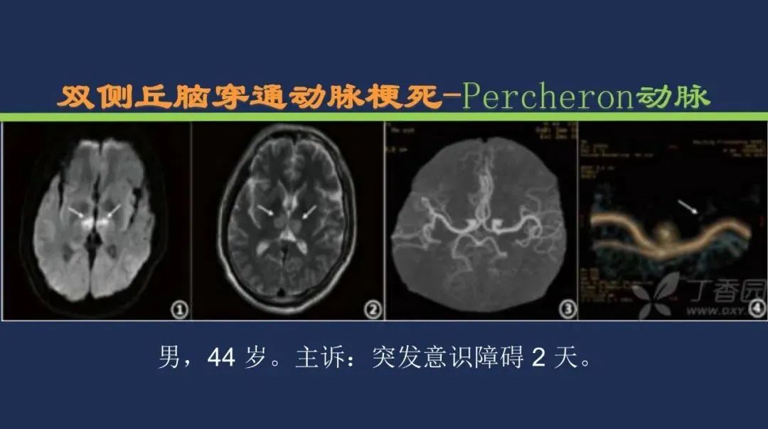 从梗死部位推测责任血管：脑血管解剖-113