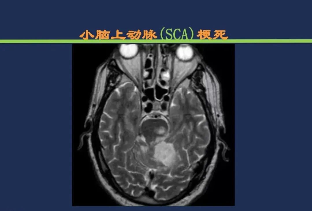 从梗死部位推测责任血管：脑血管解剖-127
