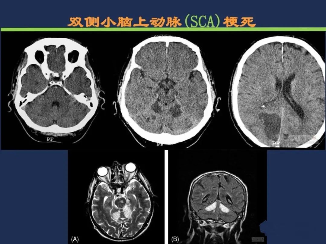 从梗死部位推测责任血管：脑血管解剖-128