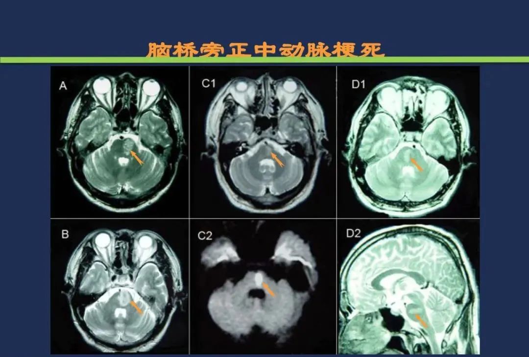从梗死部位推测责任血管：脑血管解剖-136