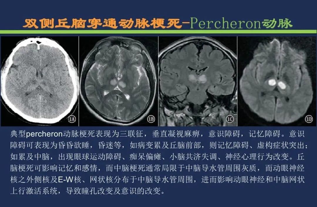 从梗死部位推测责任血管：脑血管解剖-112