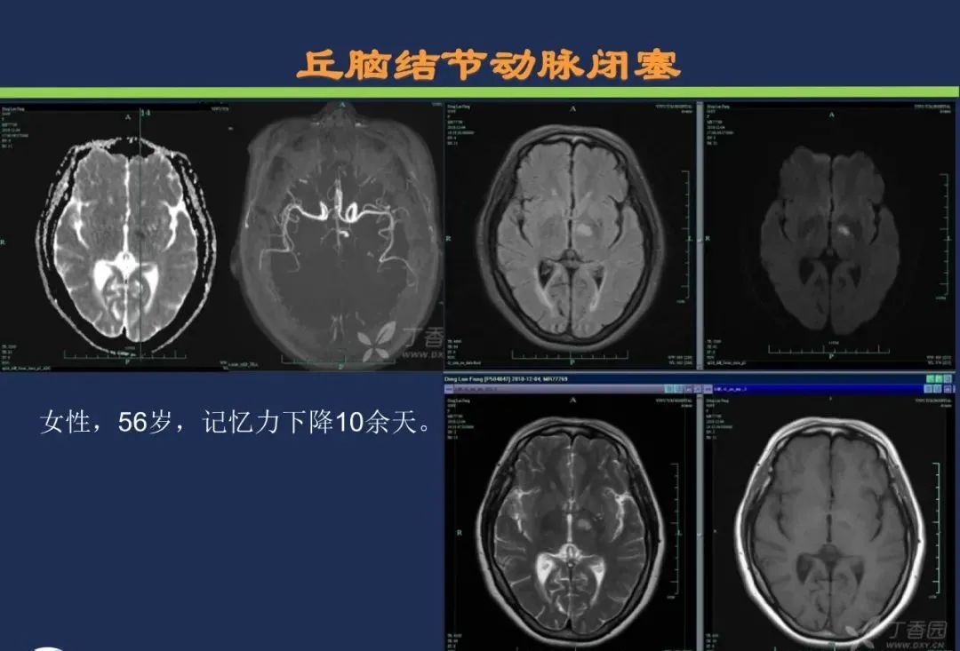 从梗死部位推测责任血管：脑血管解剖-120