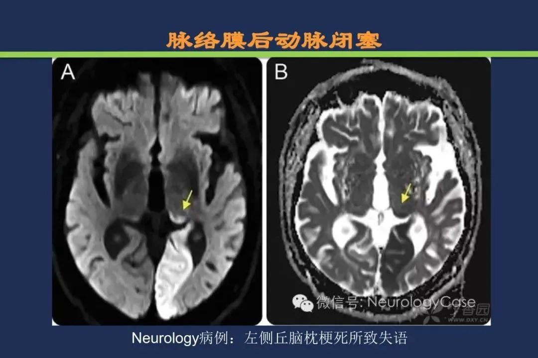 从梗死部位推测责任血管：脑血管解剖-122