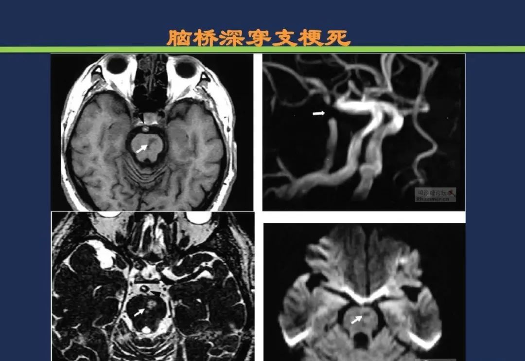 从梗死部位推测责任血管：脑血管解剖-131