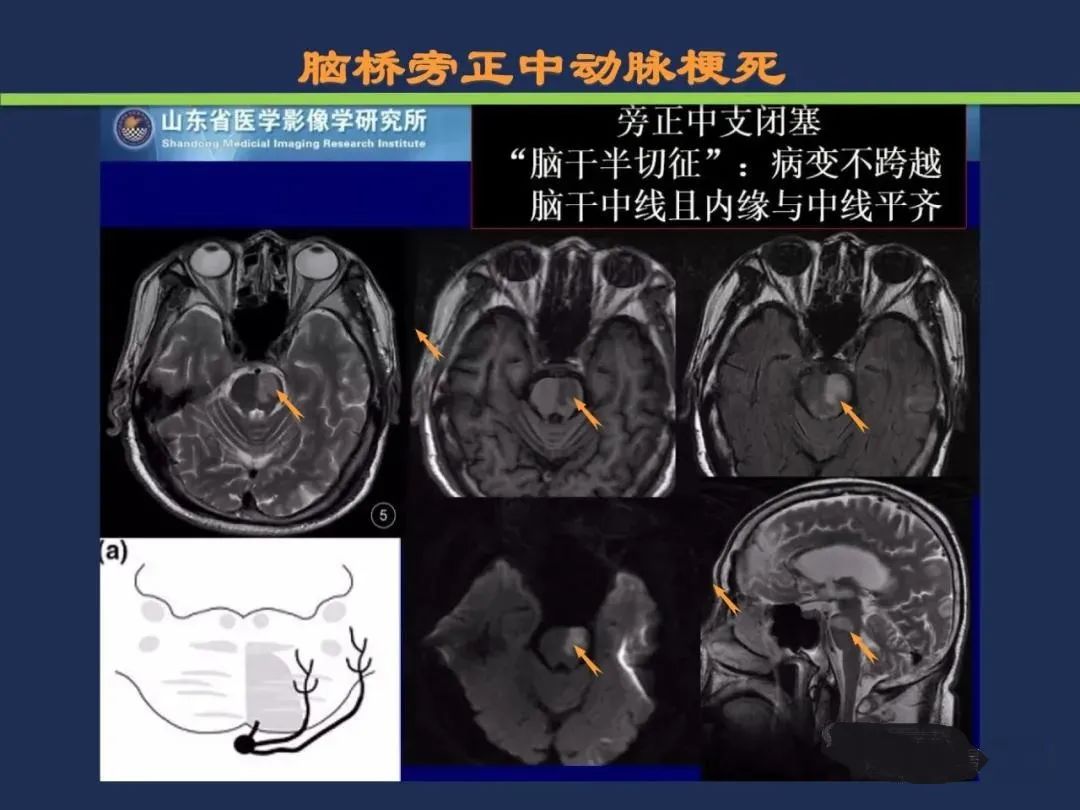 从梗死部位推测责任血管：脑血管解剖-135