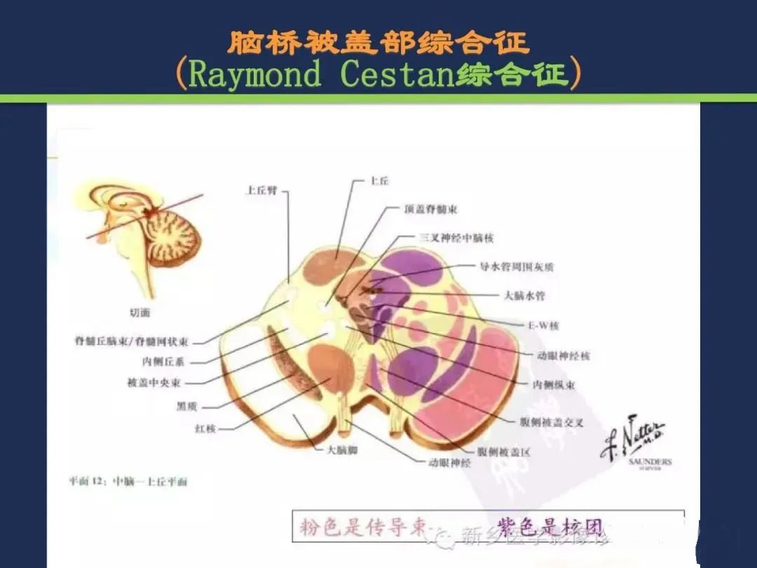 从梗死部位推测责任血管：脑血管解剖-144