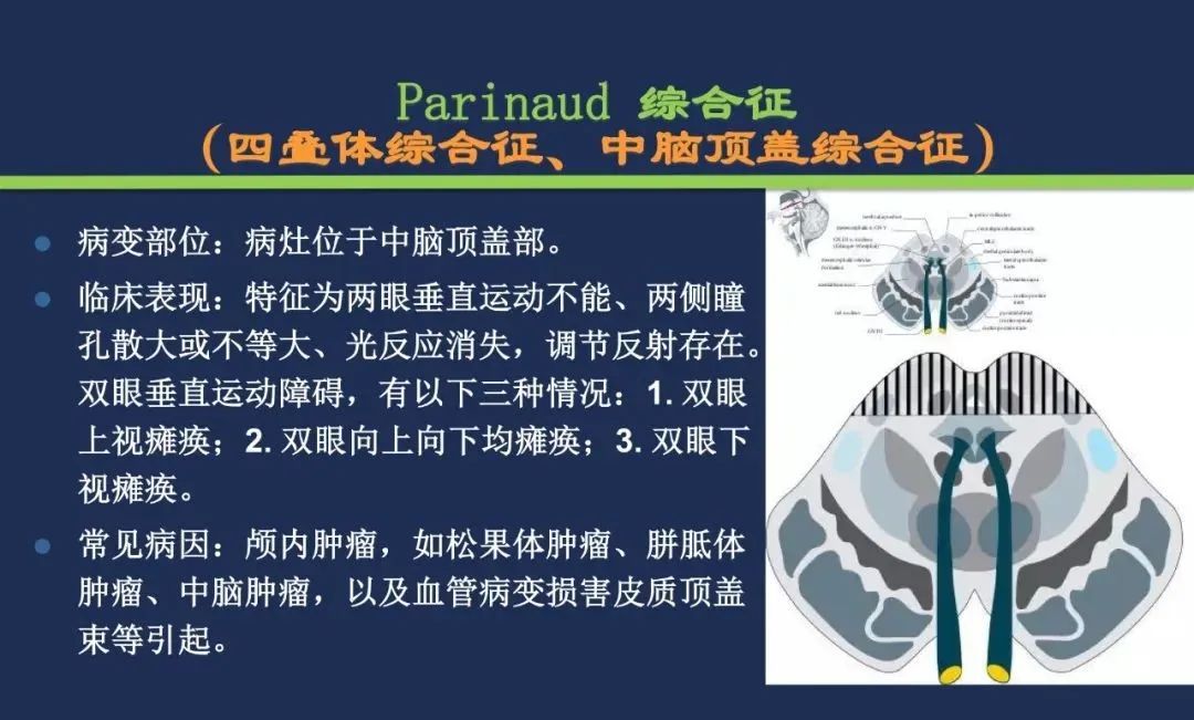 从梗死部位推测责任血管：脑血管解剖-148