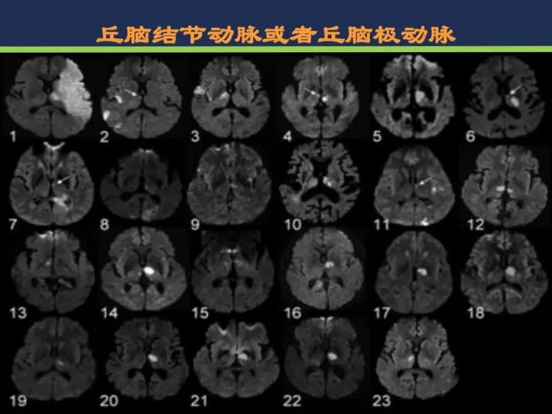从梗死部位推测责任血管：脑血管解剖-118