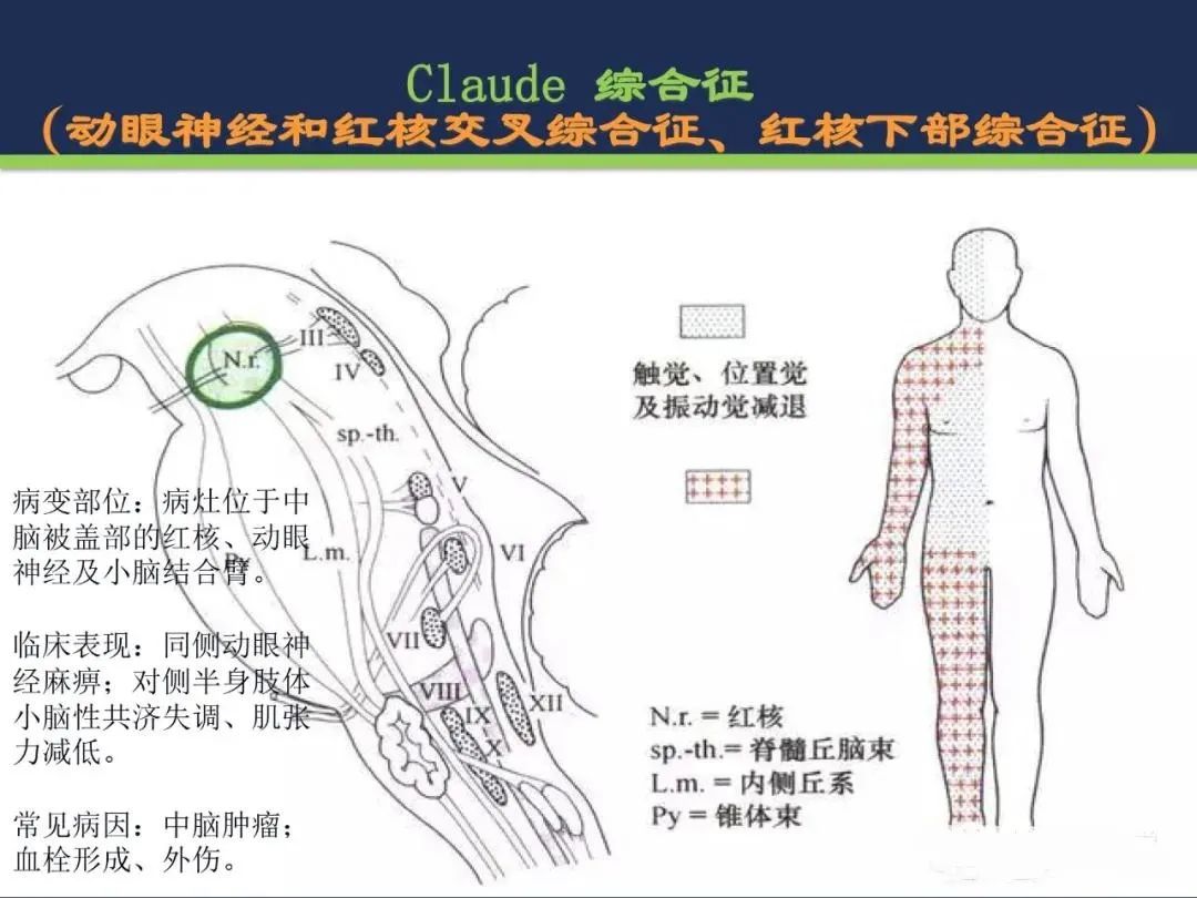 从梗死部位推测责任血管：脑血管解剖-147